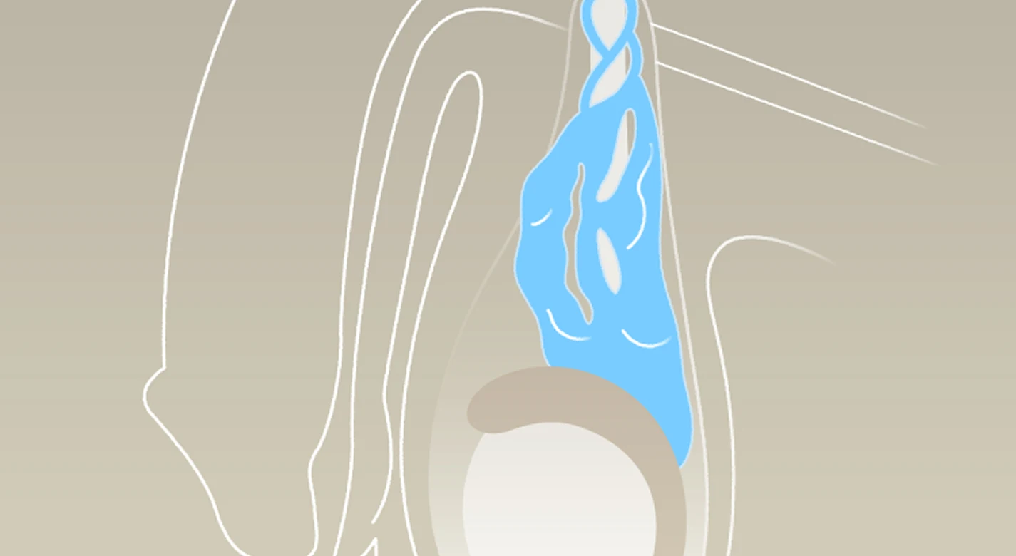 精索靜脈曲張Varicocele